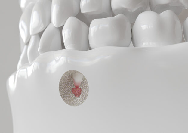 3D model of teeth and jaw that shows infection at the root of a tooth