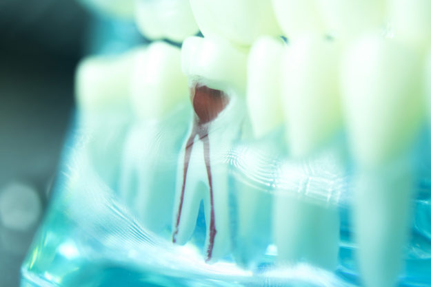 Laser Root Canals vs Traditional Root Canals tooth showing root