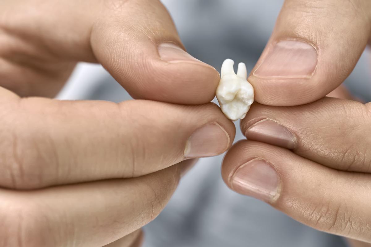 How Do You Treat an Avulsed Tooth person holding a tooth discusses avulsed tooth treatment