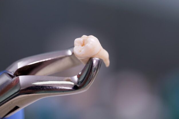 endodontist holding tooth explains apicoectomy vs extraction