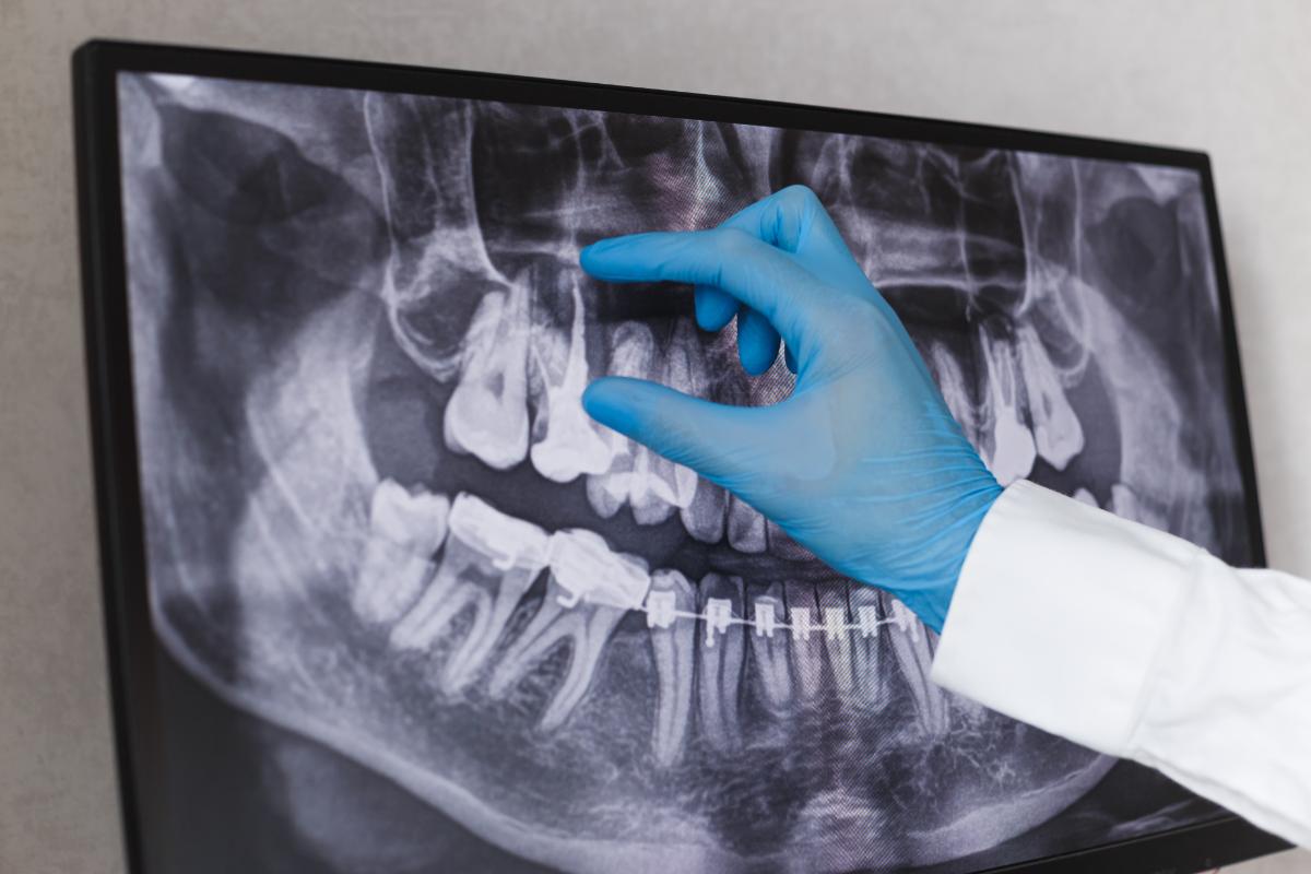What to Do When You Have a Dental Root Fracture_ endodontist points at dental root fracture treatment options