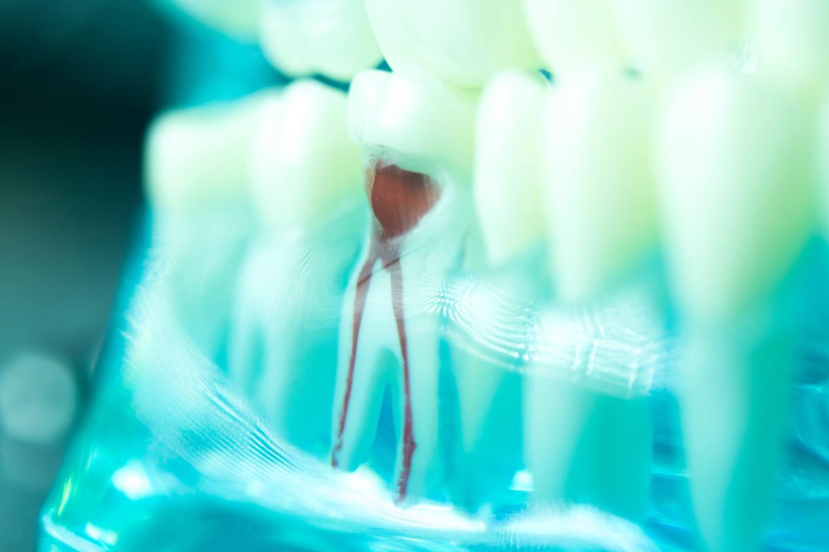 When Is a Root Canal Therapy Necessary_ image of canals in a tooth to show when is a root canal needed