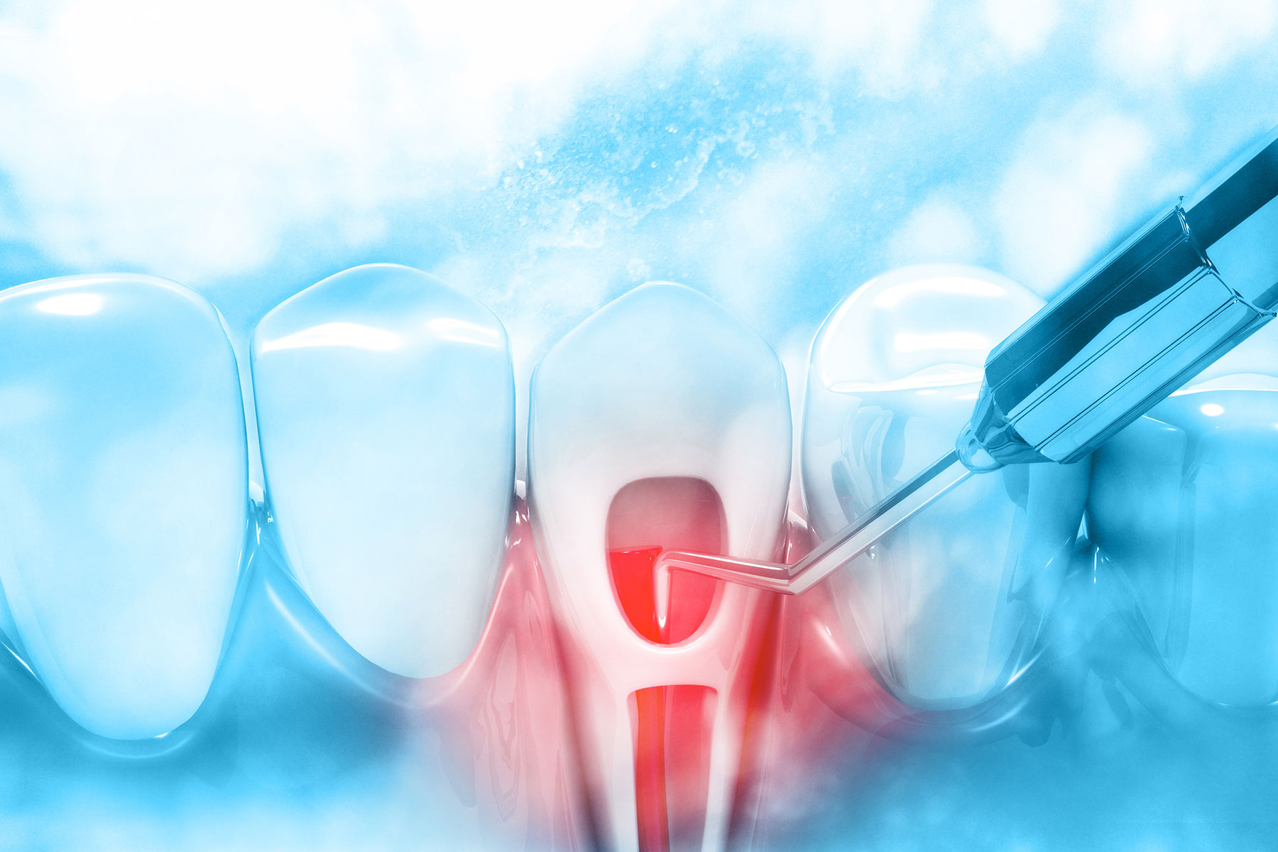 Root Canal Aftercare Visualization of root canal aftercare