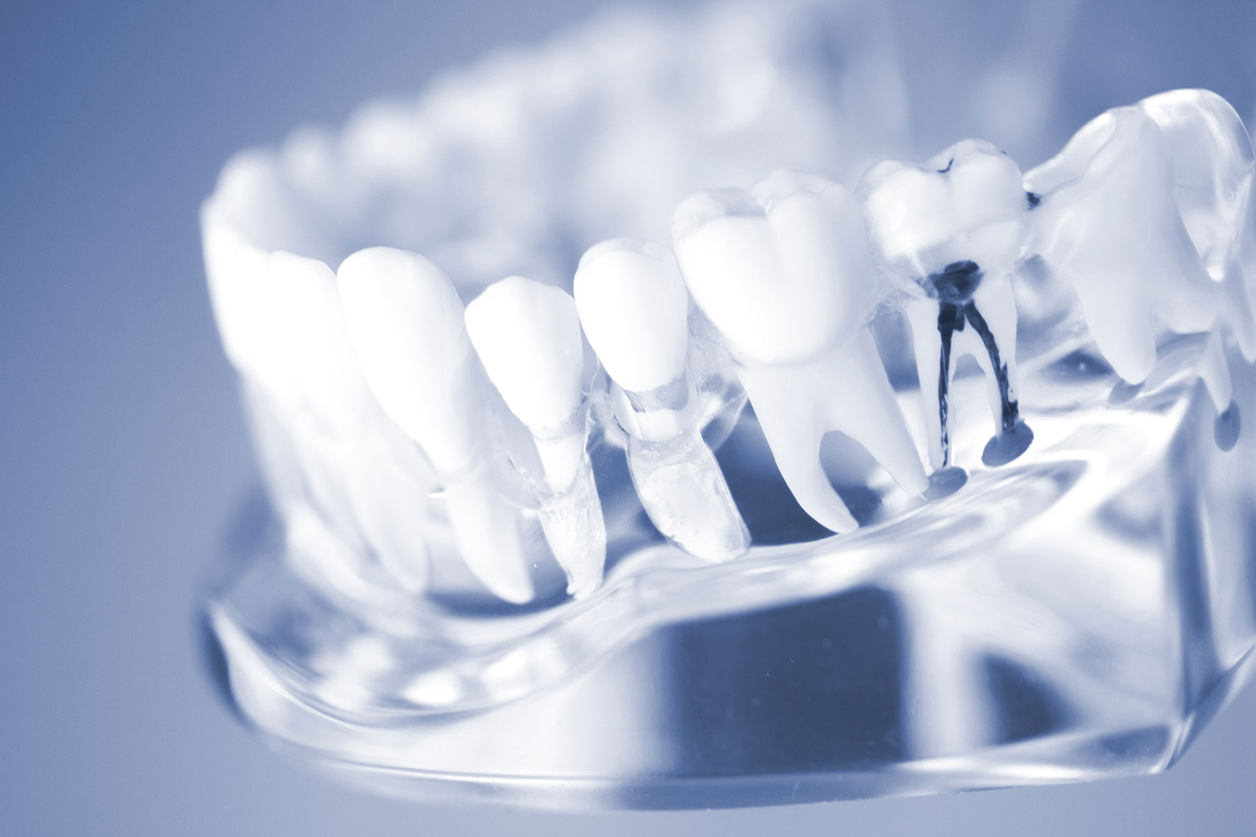 Root Canal vs. Extraction Endodontic Treatment MD