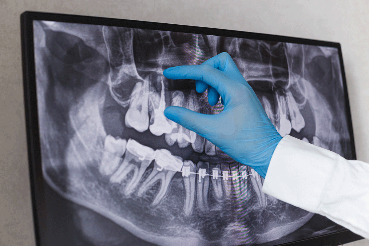 an endodontist shows the need for a pulpotomy on an x ray