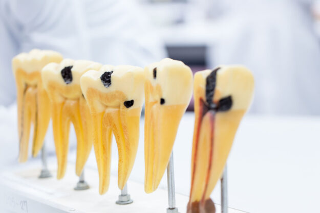 model of teeth that shows progression of decay up to root canal