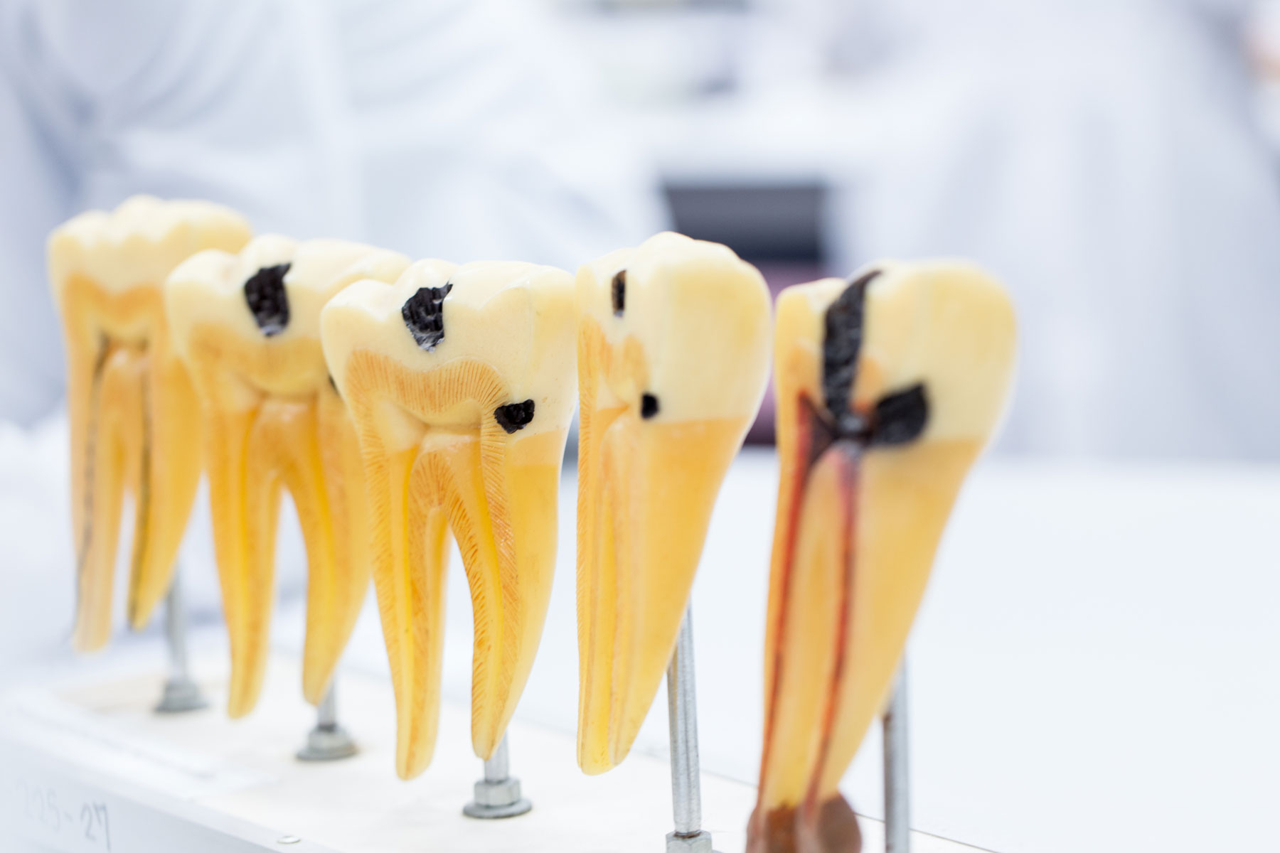 How Does a Root Canal Save Your Tooth from Infection model of teeth that shows progression of decay up to root canal