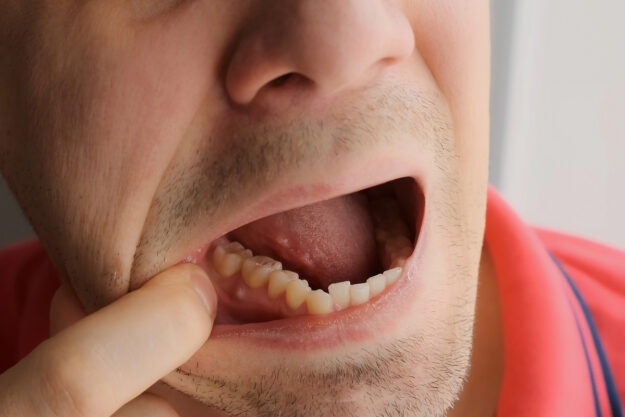 Tooth-Abscess—Causes,-Symptoms,-and-Treatment Man pulling lip to show tooth abscess