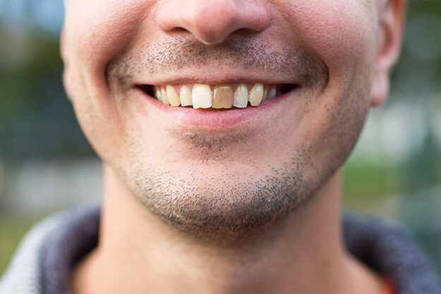 Can a Cracked Tooth Be Saved with a Root Canal Access Endo Image 1 Man smiling with discolored front tooth discolored from hidden crack
