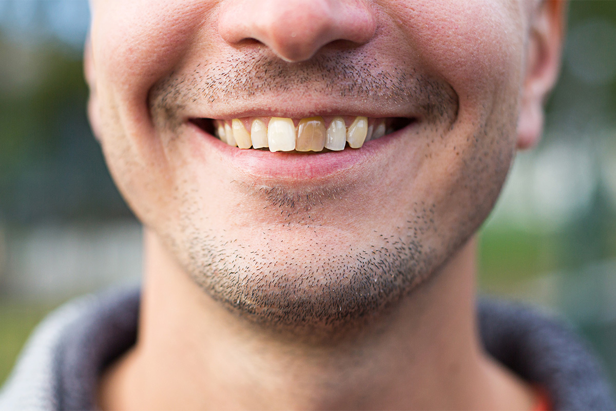 Man smiling with discolored front tooth discolored from hidden crack