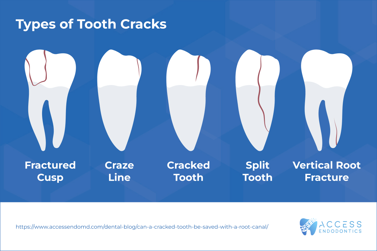 Types of Tooth Cracks Infographic Types of cracked teeth and when root canal treatment may help save the tooth
